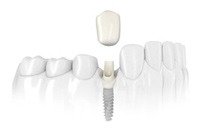Single Tooth Solution
