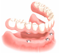 Permanent bottom arch denture supported by Dental Implants