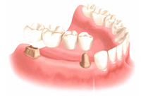 Traditional Tooth-supported bridge